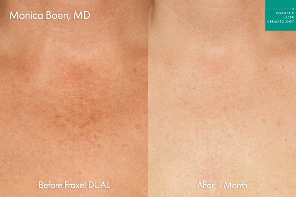Real patient fraxel results in San Diego