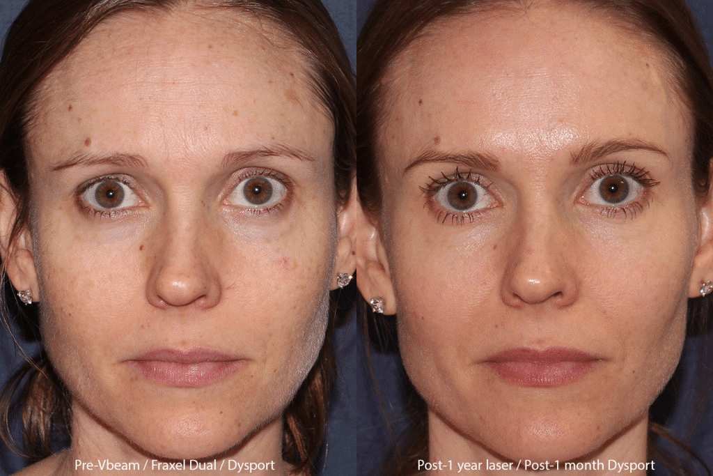 Before and after fraxel laser in San Diego