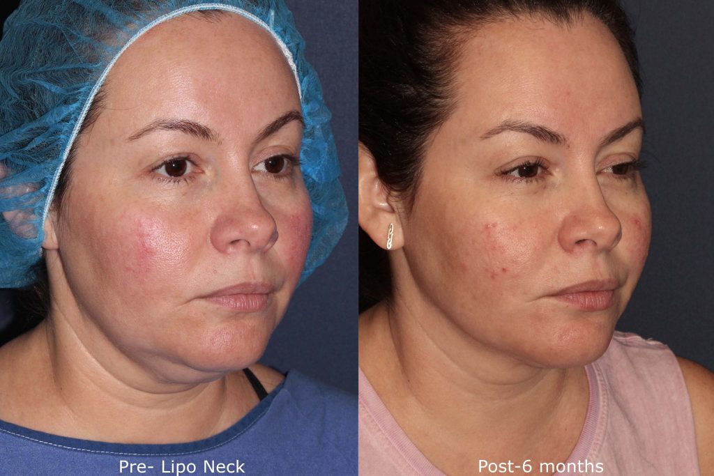 Before and after liposculpture in San Diego