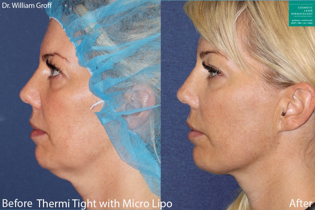 Before and after neck tightening in San Diego