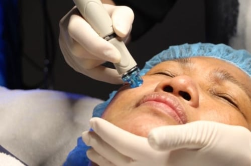 Provider performing microneedling procedure on ethnic patient in San DIego