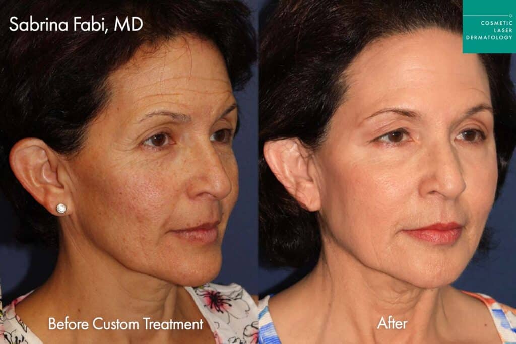 Ulthera Fraxel Laser Resurfacing, VBEam, PDT, Cunergy, IPL, Botox, Filler by Dr. Fabi before and after photos of a female patient after 9 years