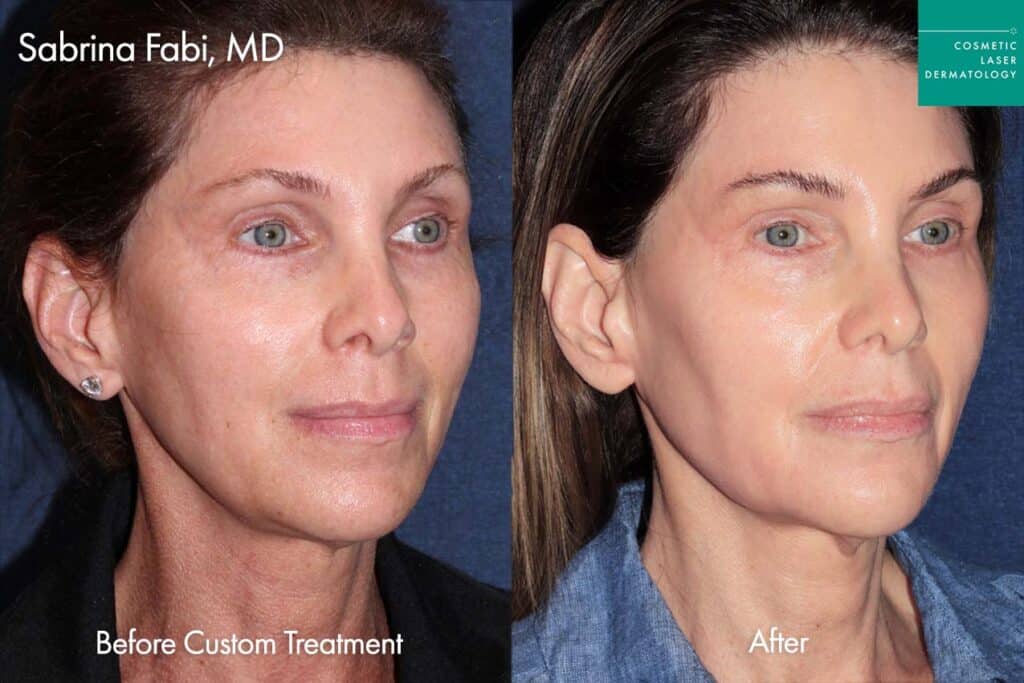 before and after dermal filler and customized treatment
