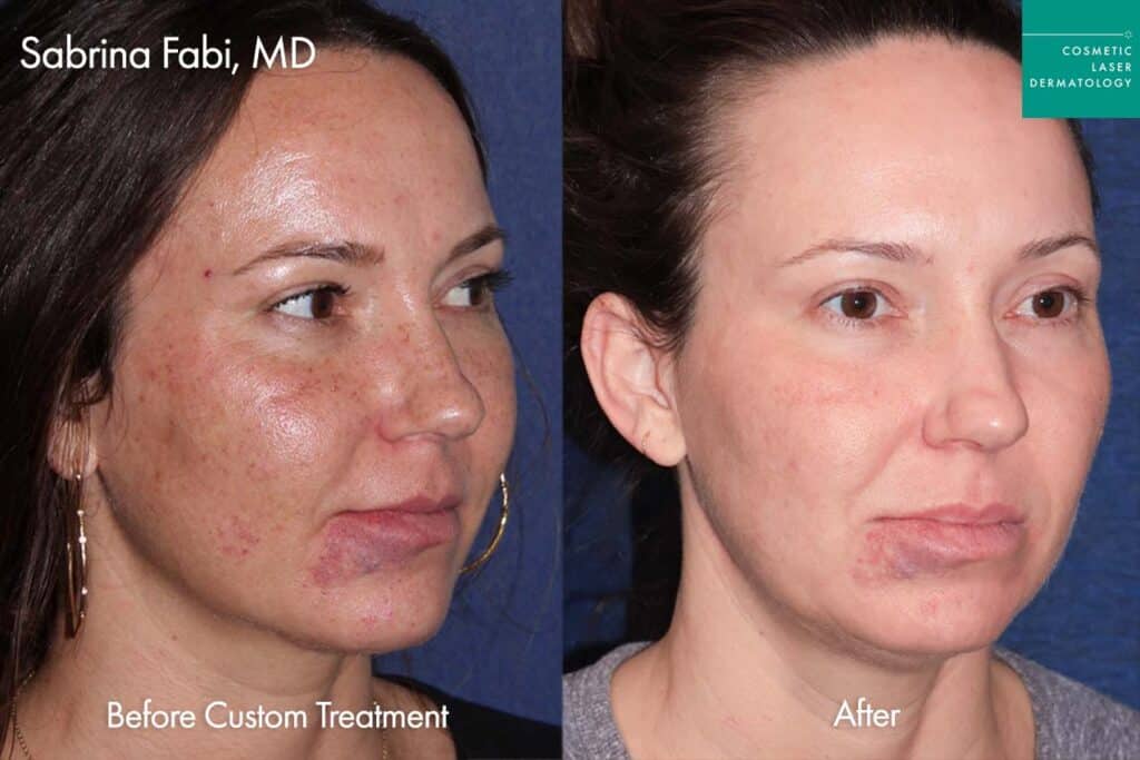 IPL Treatment before and after photos of a female patient of Cosmetic Laser Dermatology