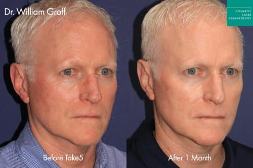 Male patient before and after laser skin resurfacing with Take5 at Cosmetic Laser Dermatology in San Diego