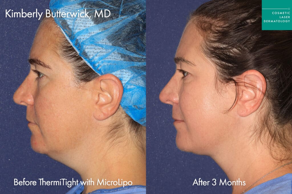 before and after neck tightening in san diego 