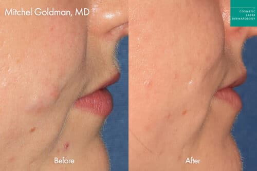 Patient before and after facial cyst removal in San Diego