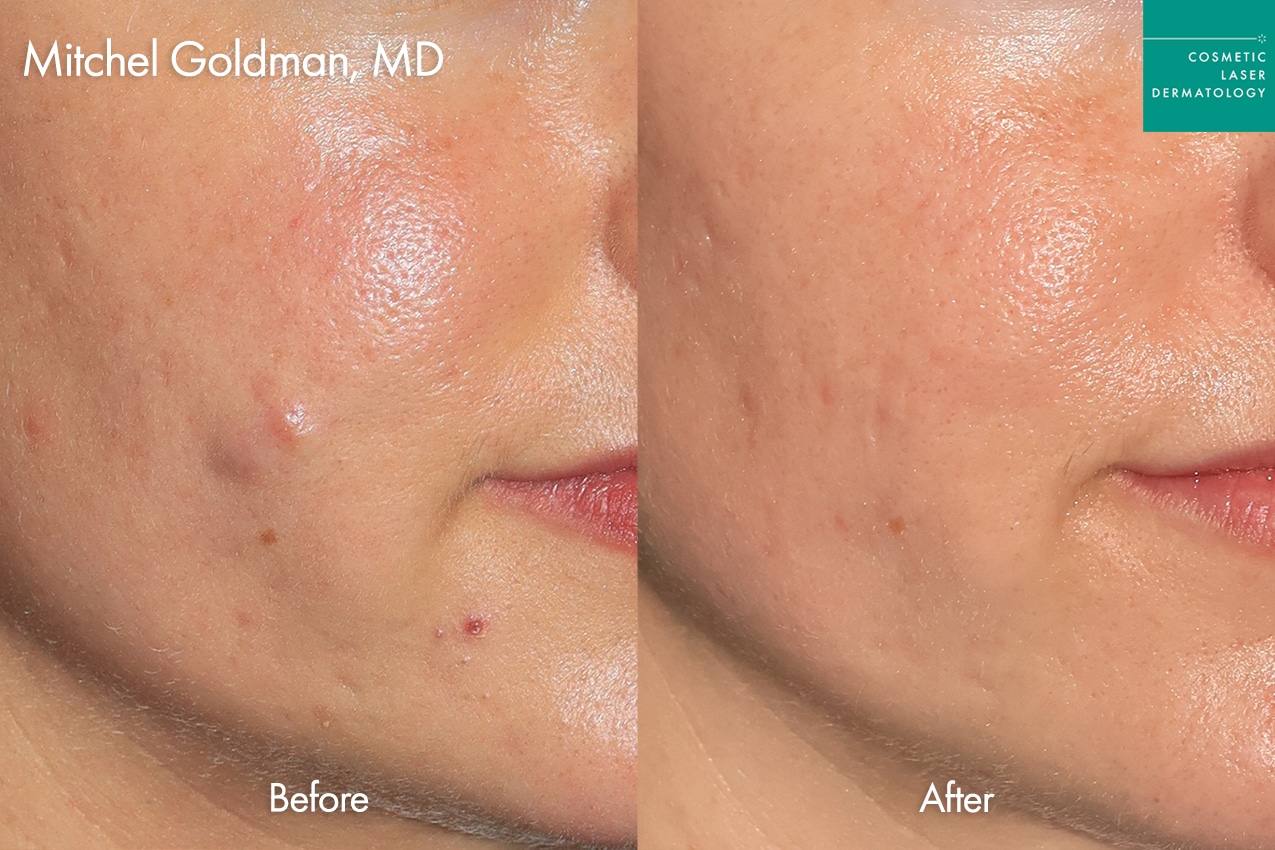 Facial Cysts treatment before and after results at Cosmetic Laser Dermatology in San Diego