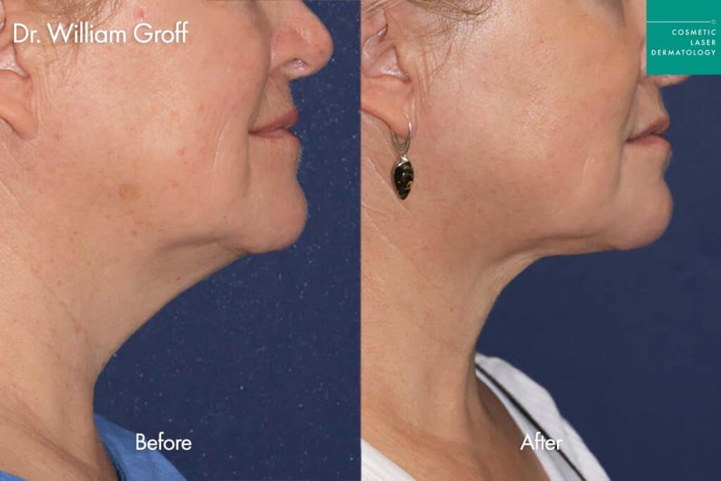 before and after non surgical neck tightening in san diego