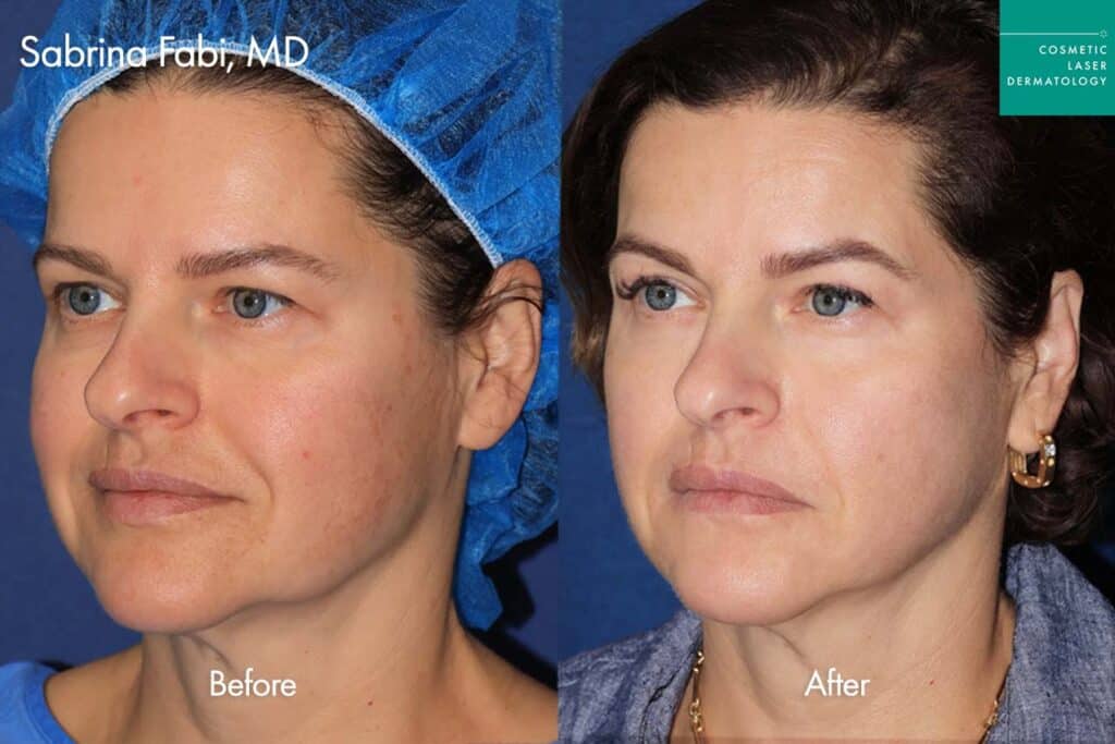 before and after ultherapy and botox in san diego
