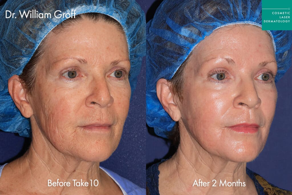 Female patient Take10 laser resurfacing results before and after treatment in San Diego