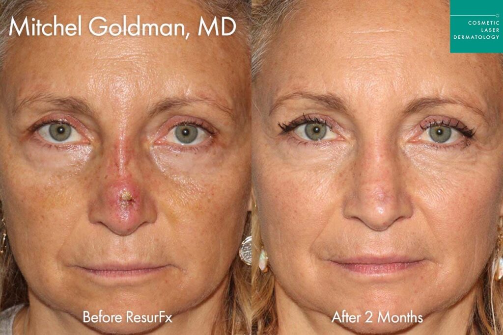 Female patient showing off results for nasal scar treatment in San Diego