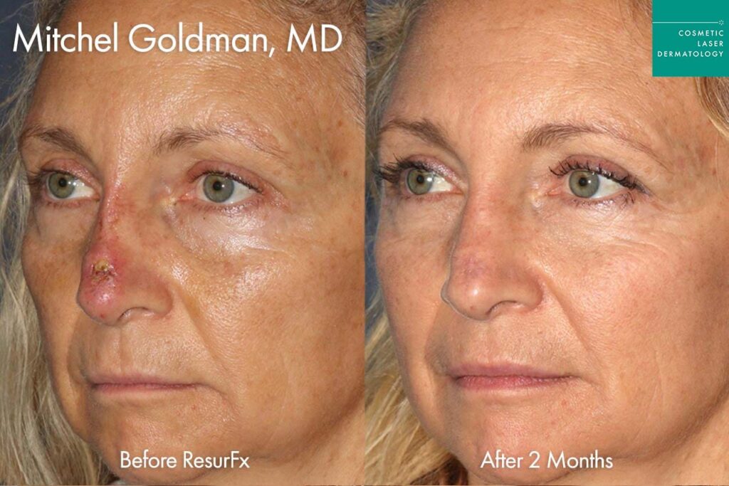Female patient showing off results for nasal scar revision in San Diego