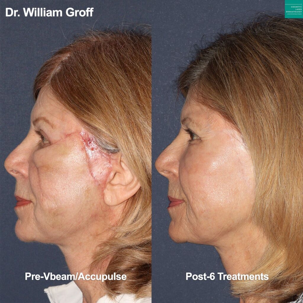 Side view of female patient's laser scar revision results in San Diego