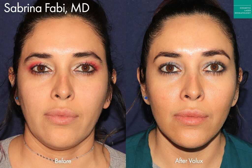 Female patient before and after jawline sculpting with Juvederm Volux in San Diego