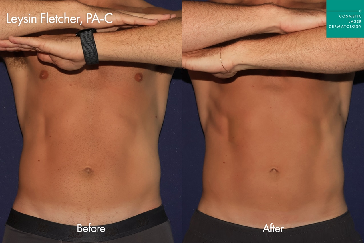 CoolTone by Leysin before and after, body sculpting on male patient