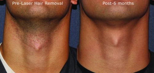 laser hair removal before and after with no razor bumps