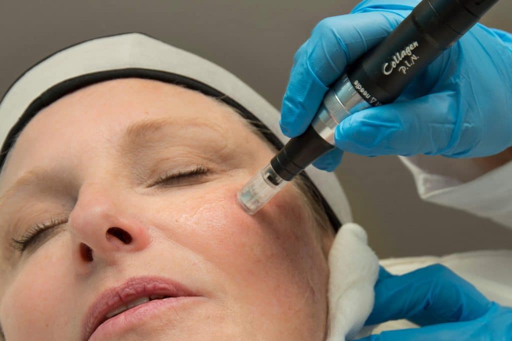 woman receiving rf microneedling treatment