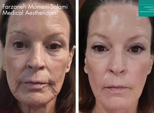 WonderTouch before and after photos of a female patient at Cosmetic Laser Dermatology (CLDerm)