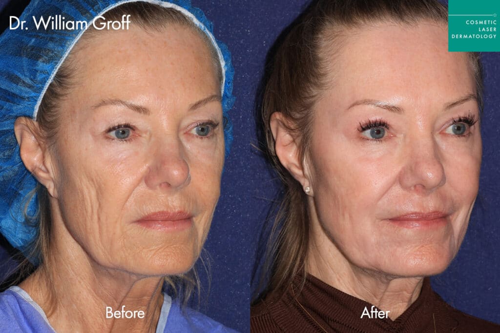 Take10 before and after photos of a female patient to treat fine lines and wrinkles in San DIego