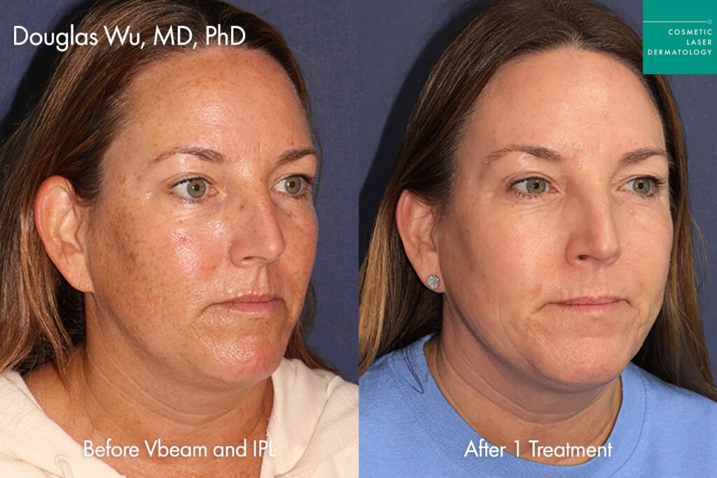 female patient results before and after IPL photofacial