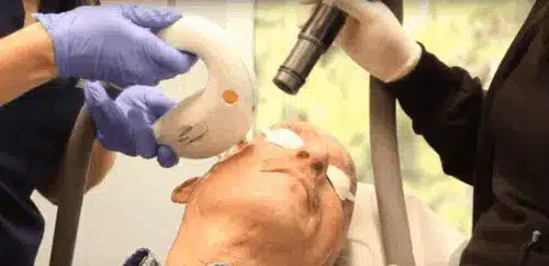 IPL STELLAR M22 LASER TREATMENT SAN DIEGO