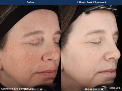 Female patient before and after 3dmiracl laser in San Diego