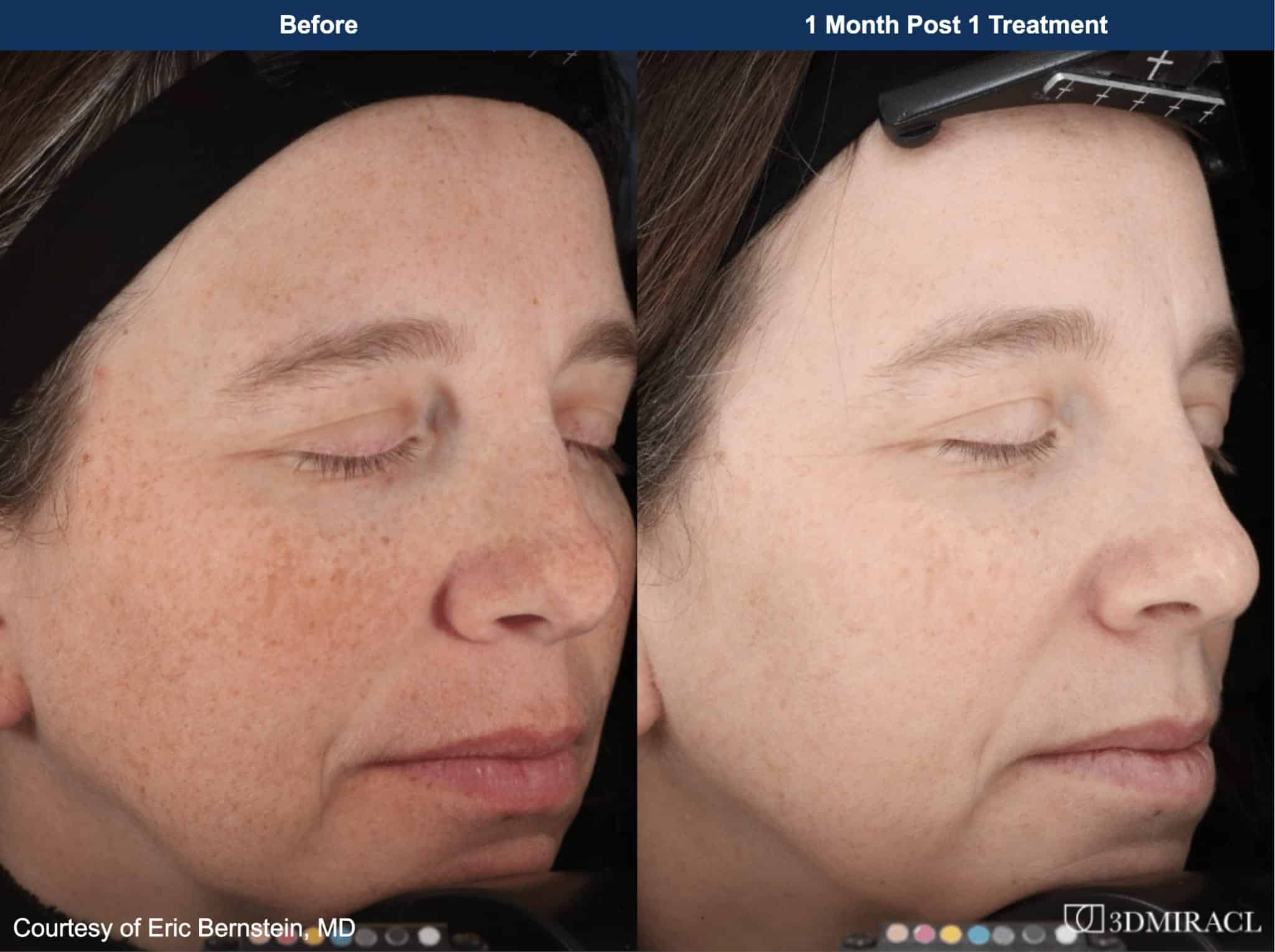 Female patient before and after 3dmiracl laser in San Diego