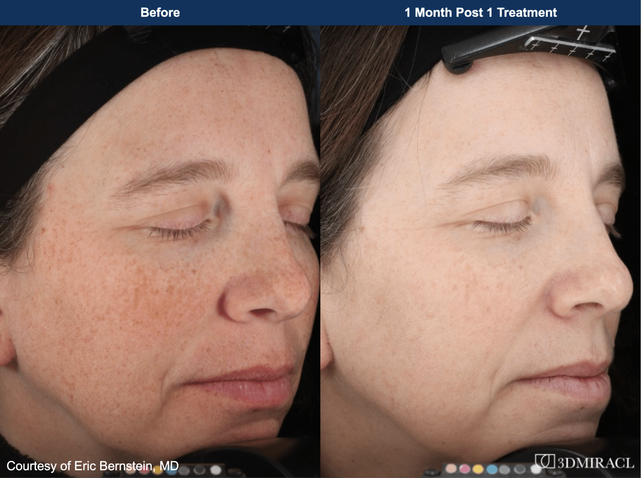 Female patient before and after 3dmiracl laser in San Diego