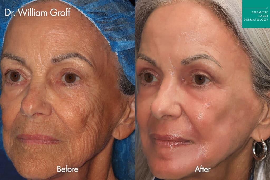 Female patient before and after Take10 laser resurfacing to treat fine lines and wrinkles in San Diego