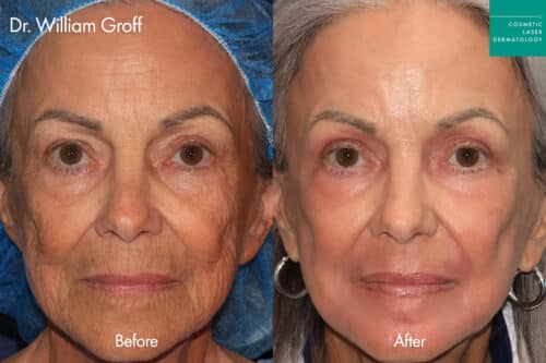before and after take 10 years off