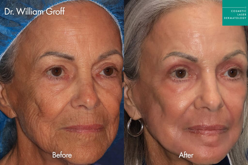 before and after take10 procedure