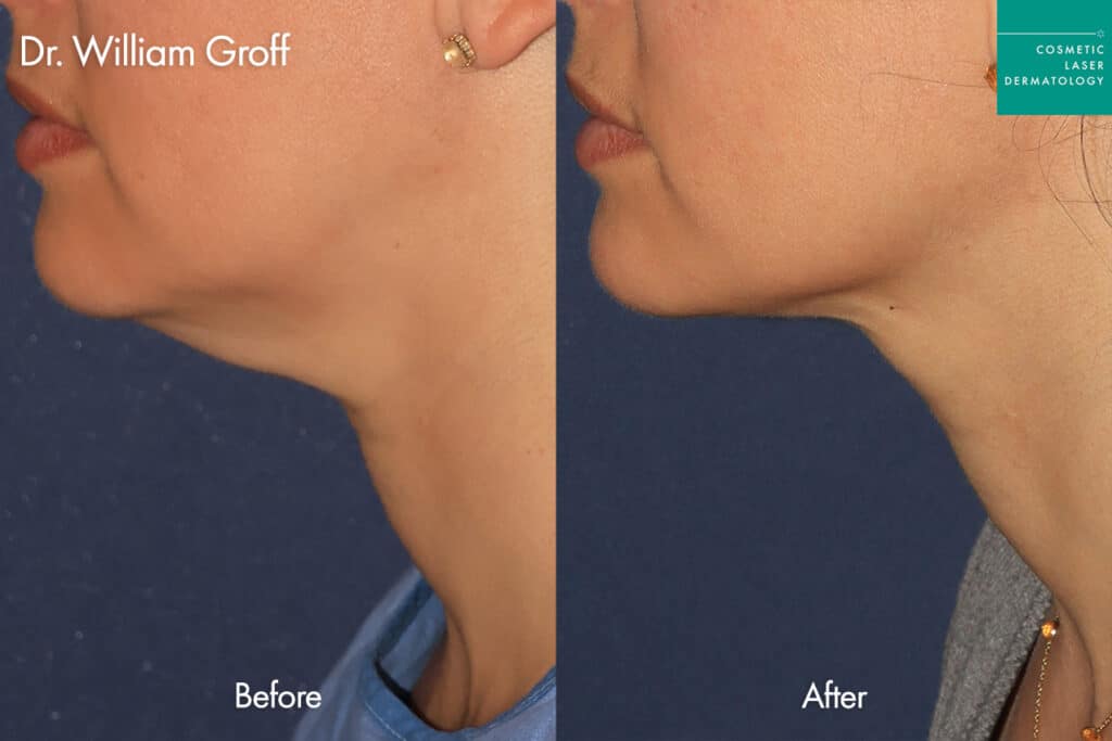 before and after thermitight and microlip for double chin