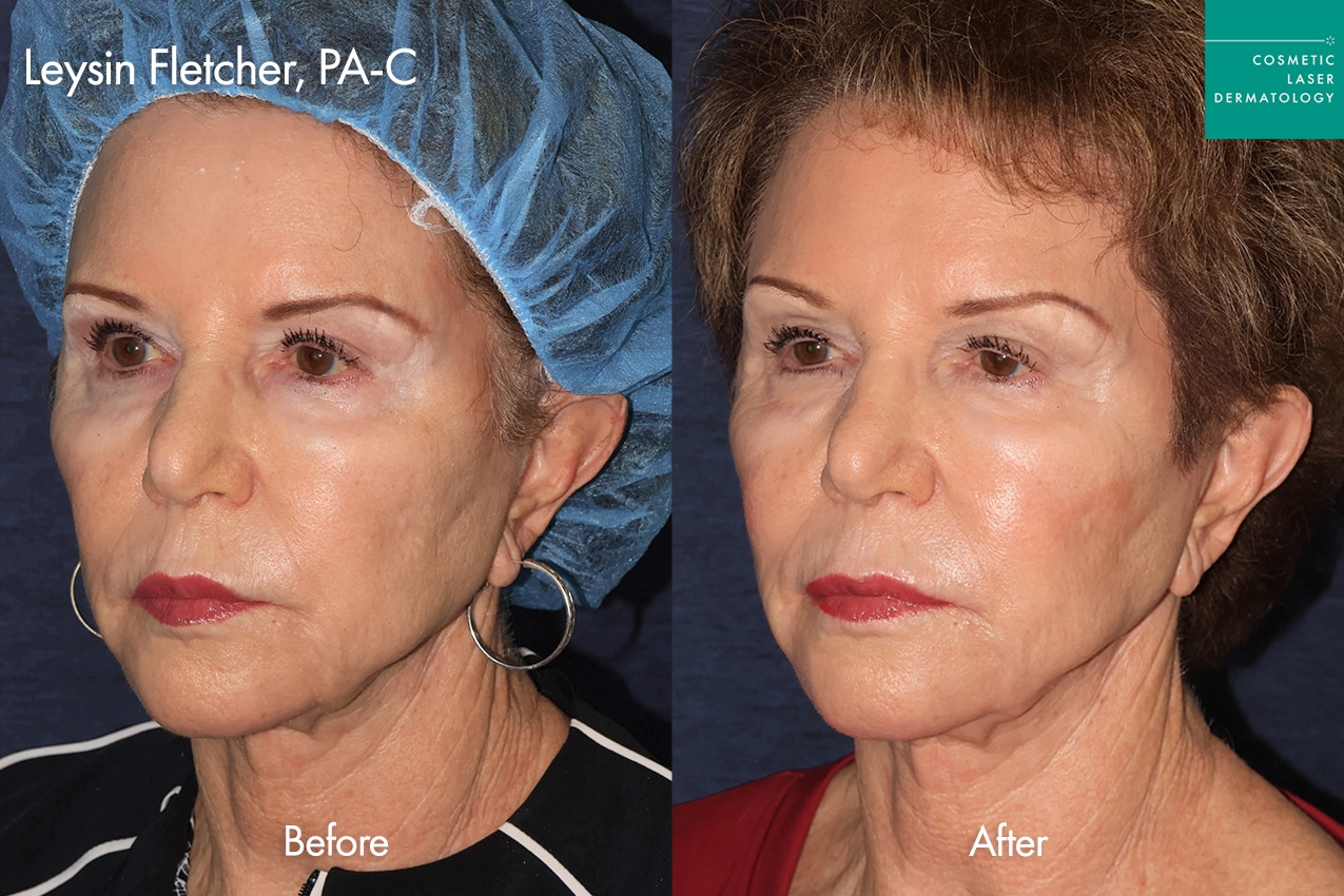 Leysin TriLift before and after