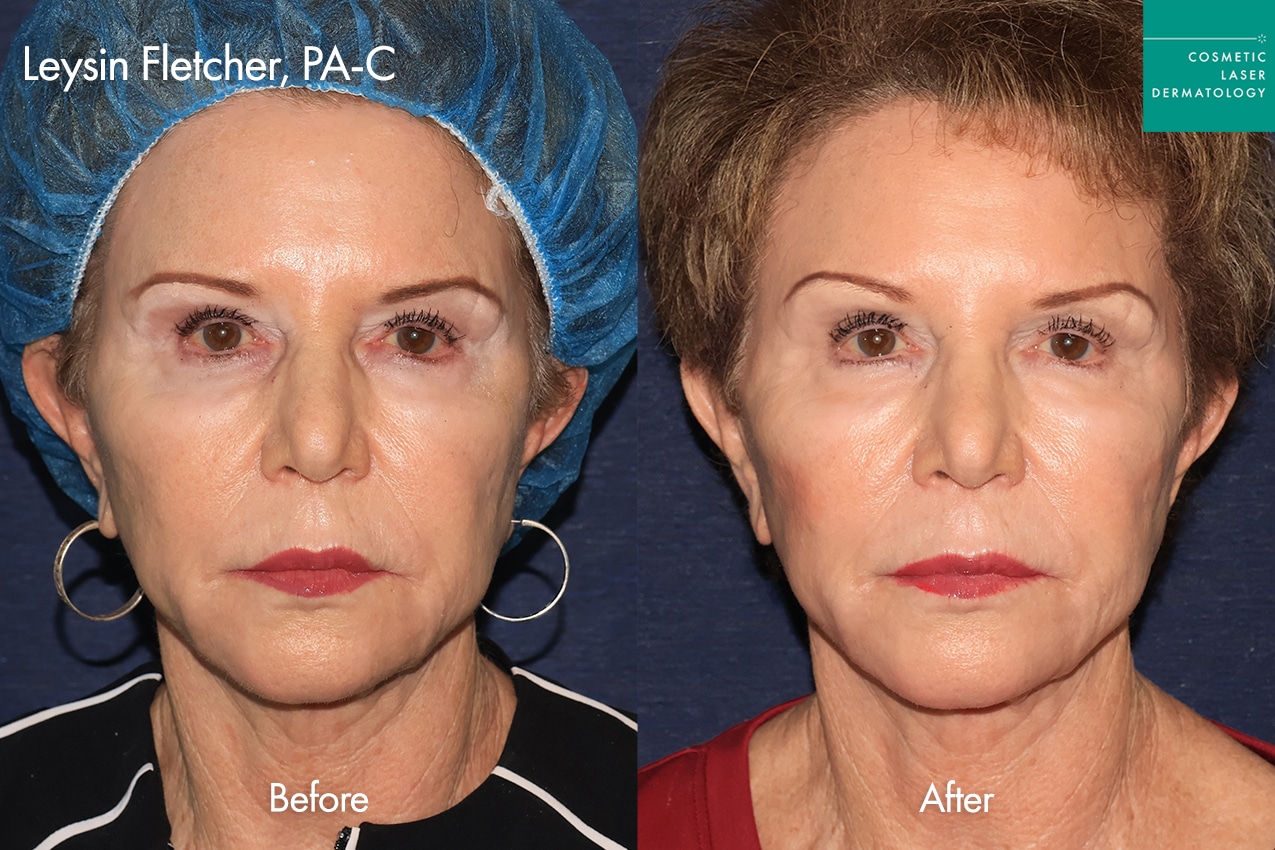 Leysin TriLift before and after