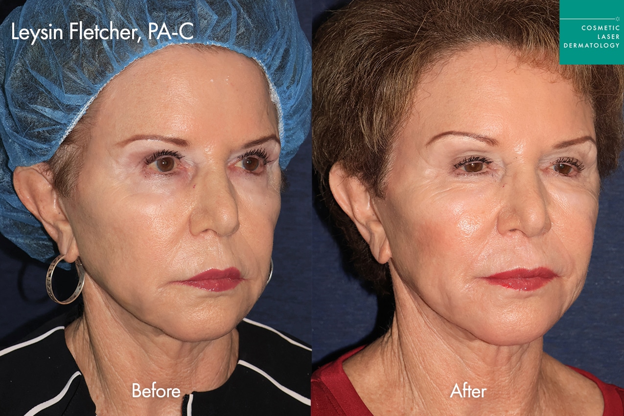 Leysin TriLift before and after