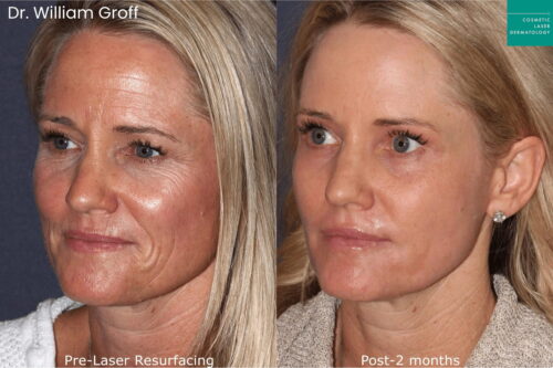 Dr. Groff Take10 before and after