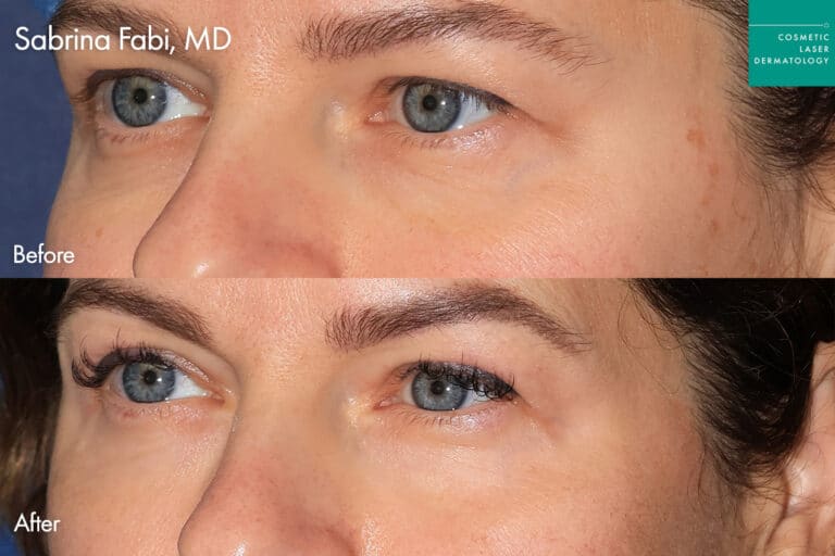 Dr. Fabi Take10Eyes before and after photos