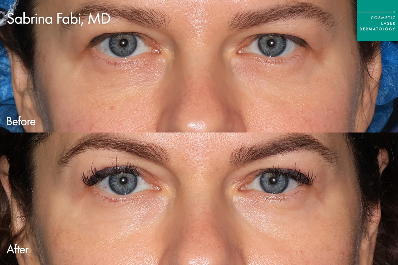 Dr. Fabi Take10Eyes before and after photos