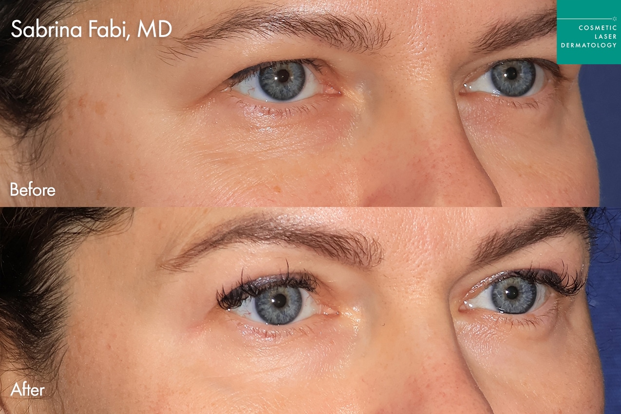 Dr. Fabi Take10Eyes before and after photos