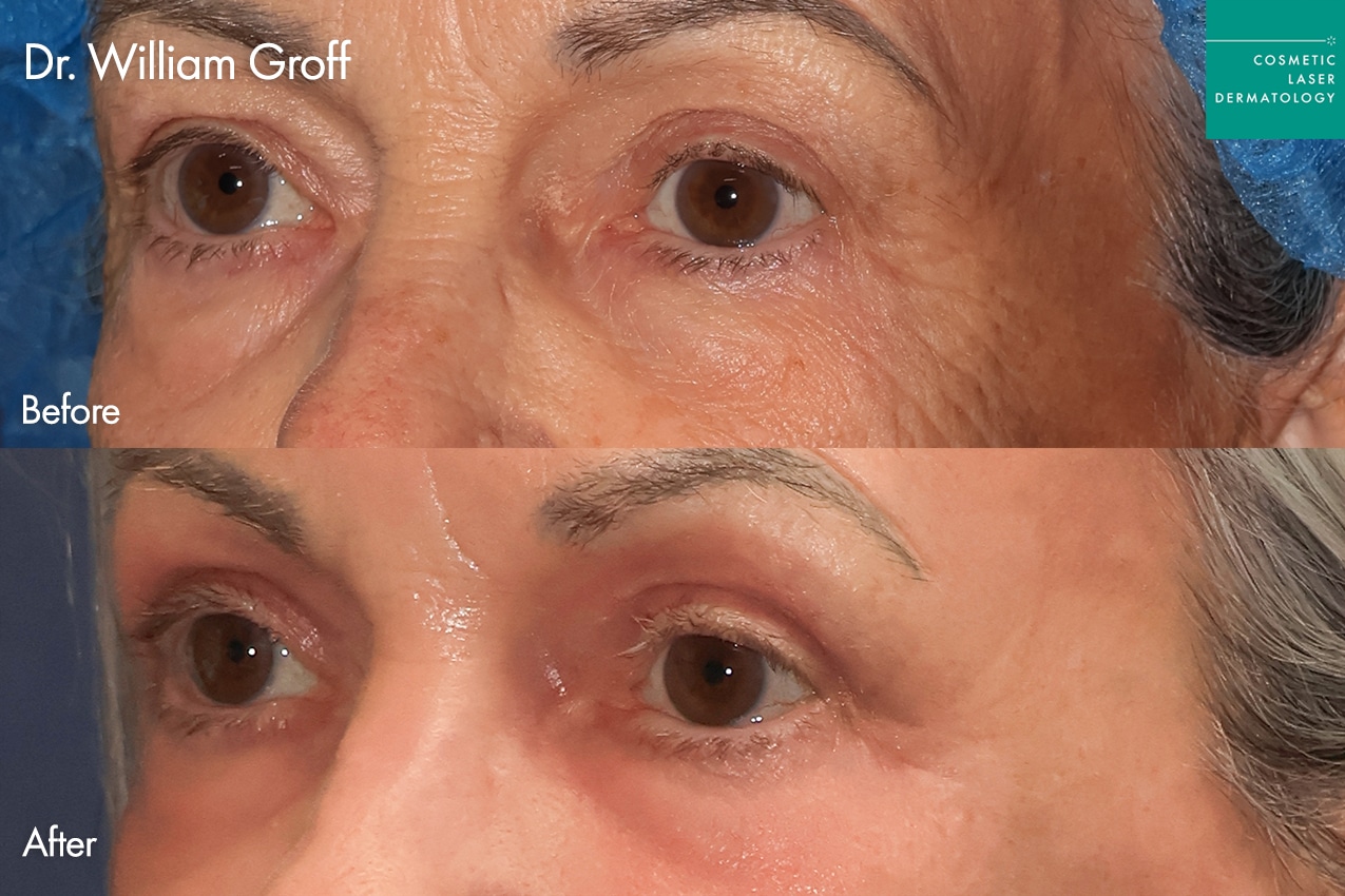 Dr. Groff Take10Eyes before and after photos