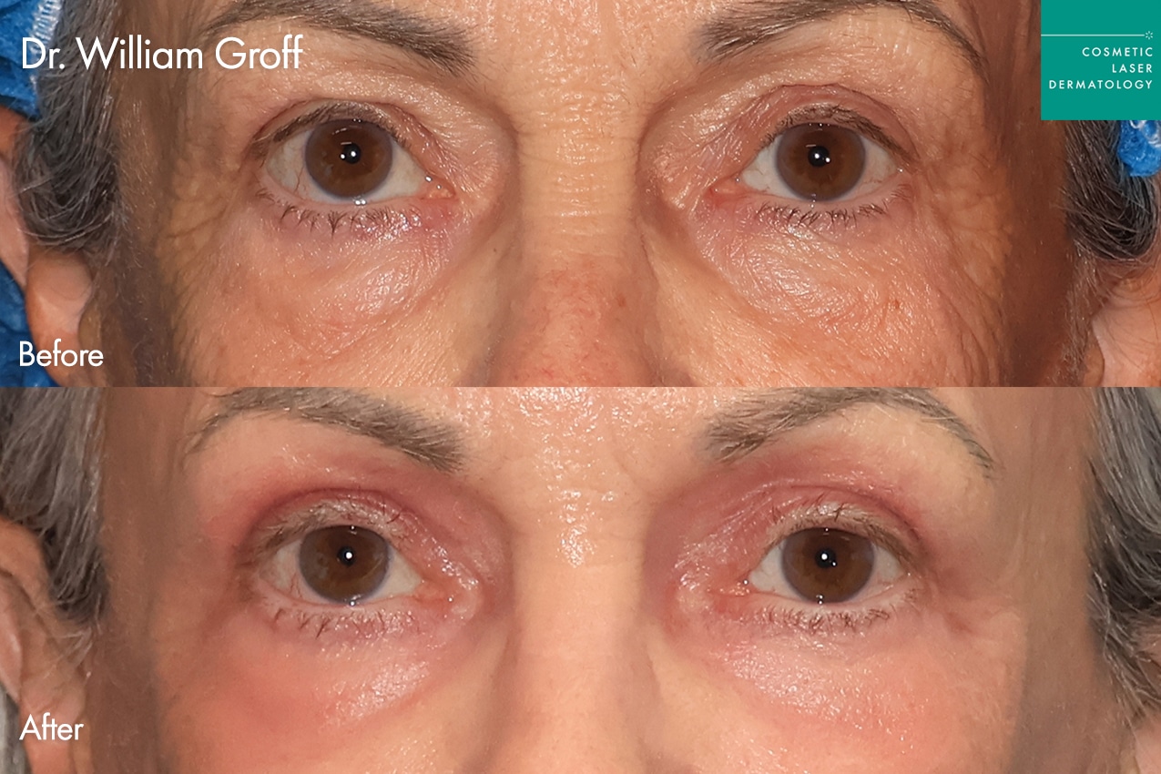 Dr. Groff Take10Eyes before and after photos
