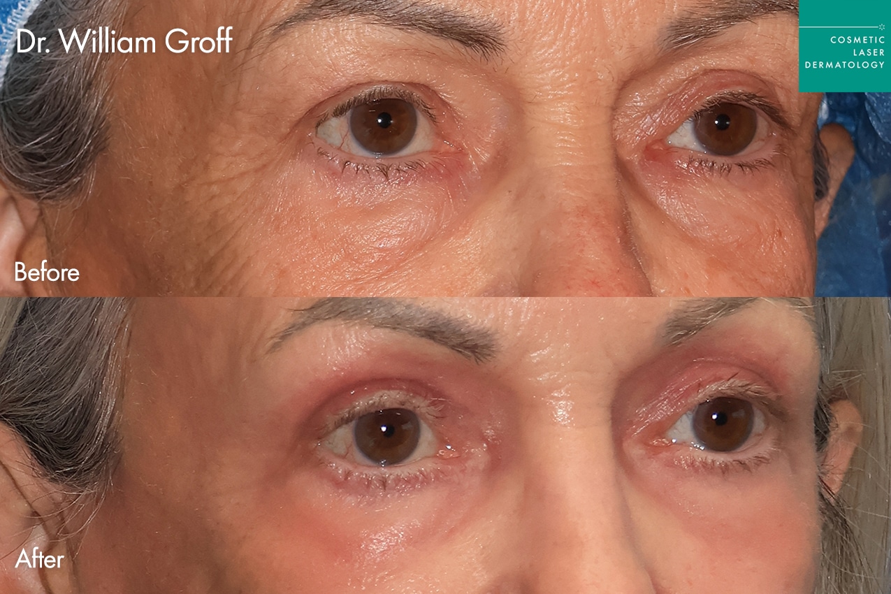 Dr. Groff Take10Eyes before and after photos