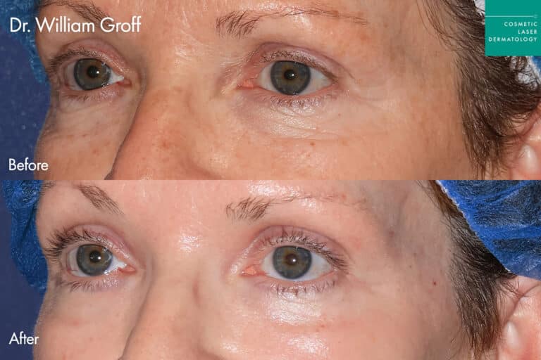 Dr. Groff Take10Eyes before and after photos