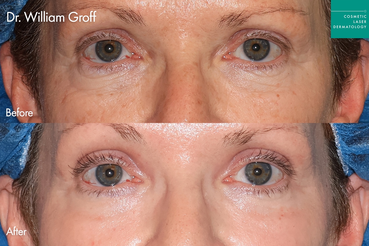 Dr. Groff Take10Eyes before and after photos