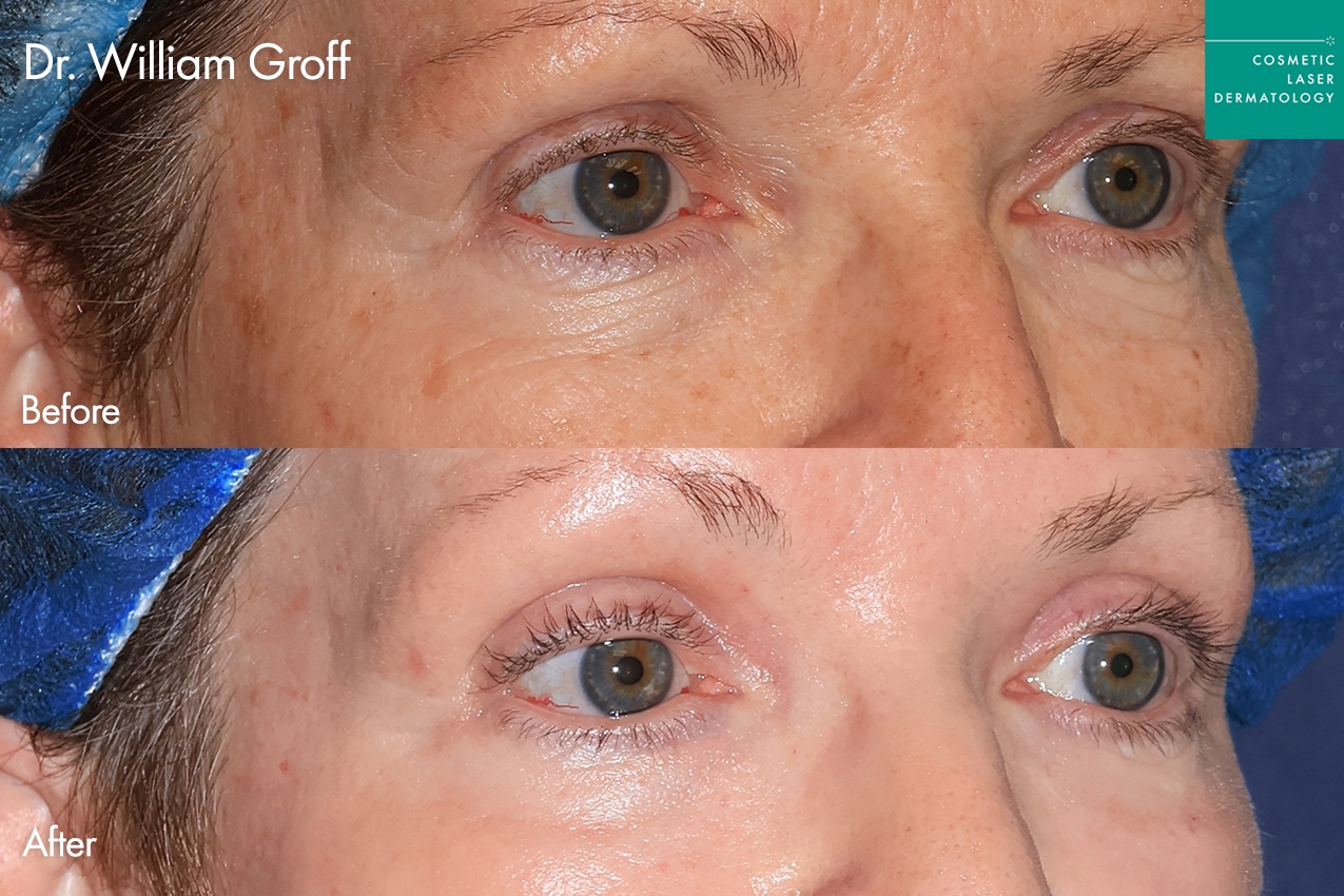 Dr. Groff Take10Eyes before and after photos