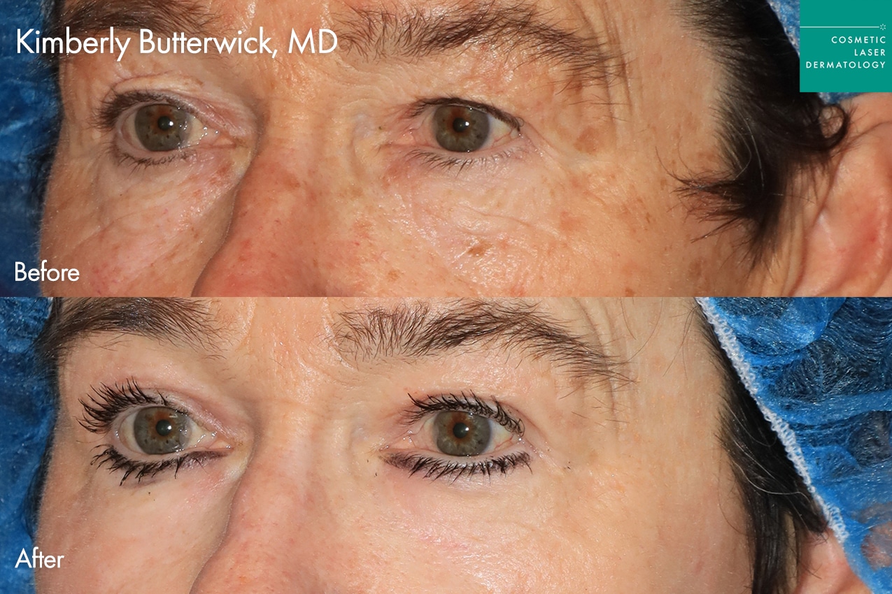 Dr. Butterwick Take10Eyes before and after photos