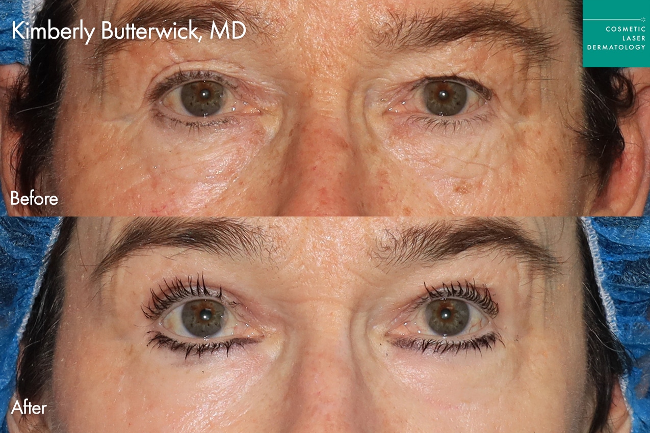 Dr. Butterwick Take10Eyes before and after photos