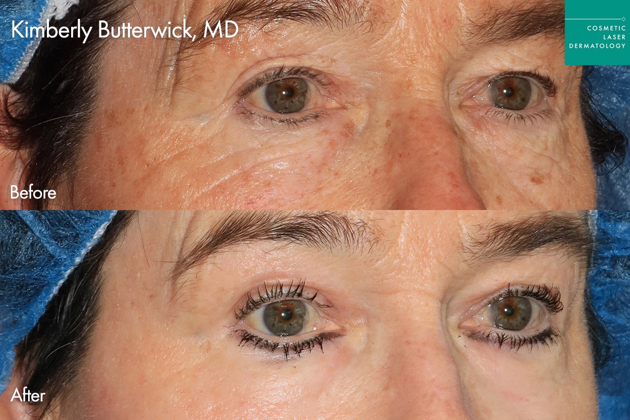 Dr. Butterwick Take10Eyes before and after photos