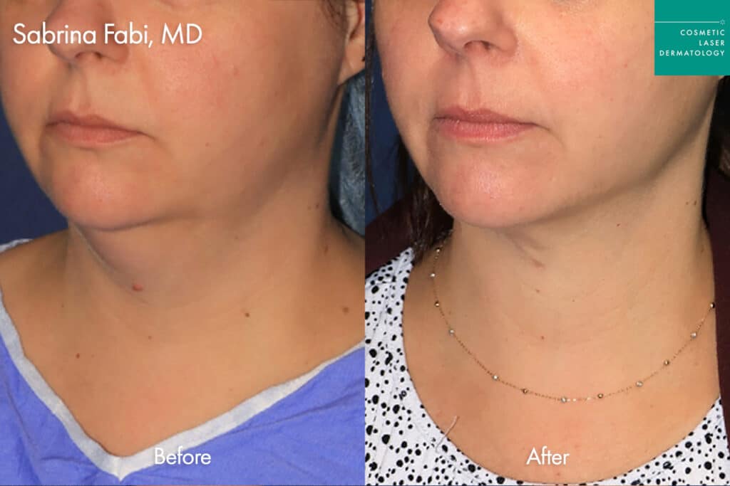 before and after non invasive skin tightening in san diego 